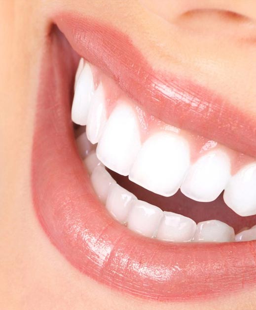veneers-dental