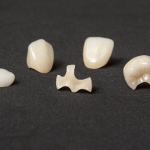 Dental Inlays and Onlays
