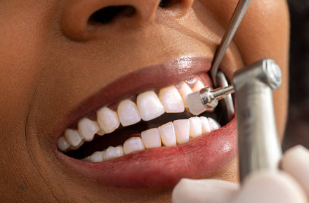 Teeth Bleaching